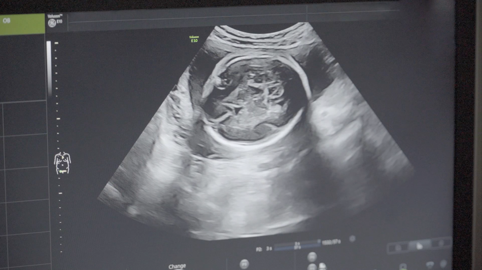 怀孕一个月b超图片图片